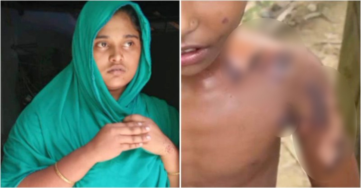 কাঁঠাল খাওয়ার অপরাধে শিশুর শরীরে গরম ছ্যাঁকা, মামী গ্রেফতার